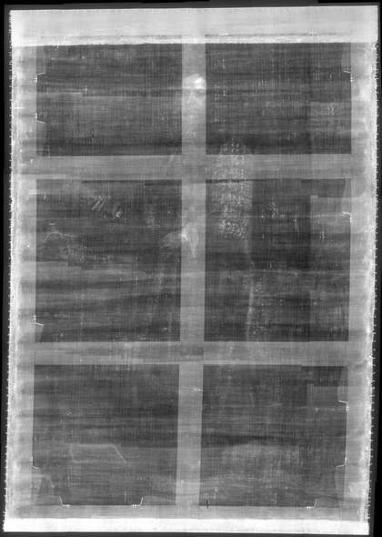 Fig.4 X-radiograph of John Smith, Speaker of the House of Commons c.1707–8