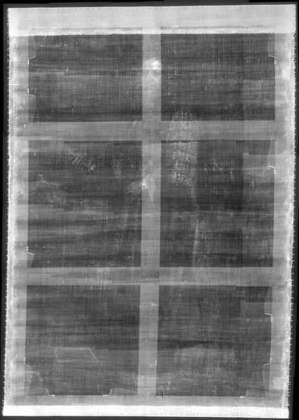 Fig.4 X-radiograph of John Smith, Speaker of the House of Commons c.1707–8