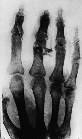 X-ray of Munch's hand