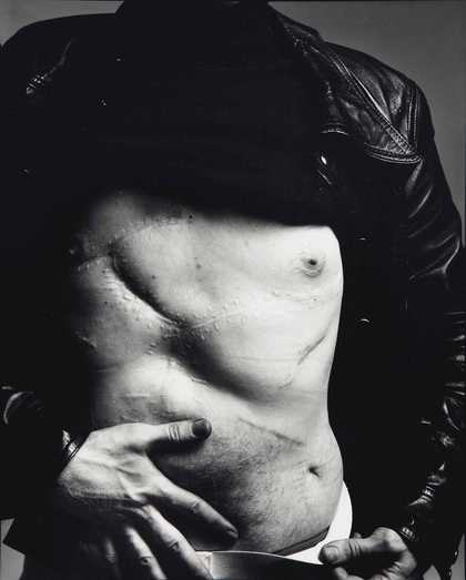 Black and white photograph of Andy Warhol's torso, scarred from being shot